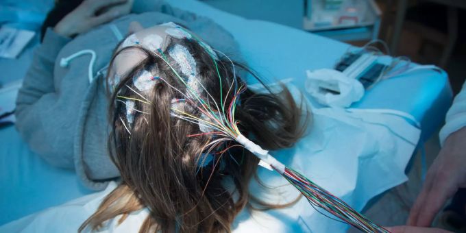 Elektroden zur Messung von Gehirnströmen (EEG) sind bei einer an Epilepsie erkrankten Patientin auf der Kopfhaut befestigt. (Symbolbild) epilepsie