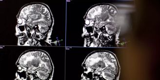 Tentakel - Neuartige Elektroden sollen künftig bei Depressionen helfen