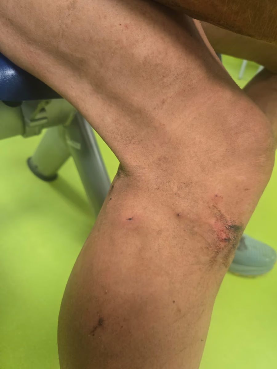 Der Trailrunner hinkt Wochen nach der Attacke immer noch, wie er berichtet. Abgebildet: Die Verletzungen nach der Attacke.