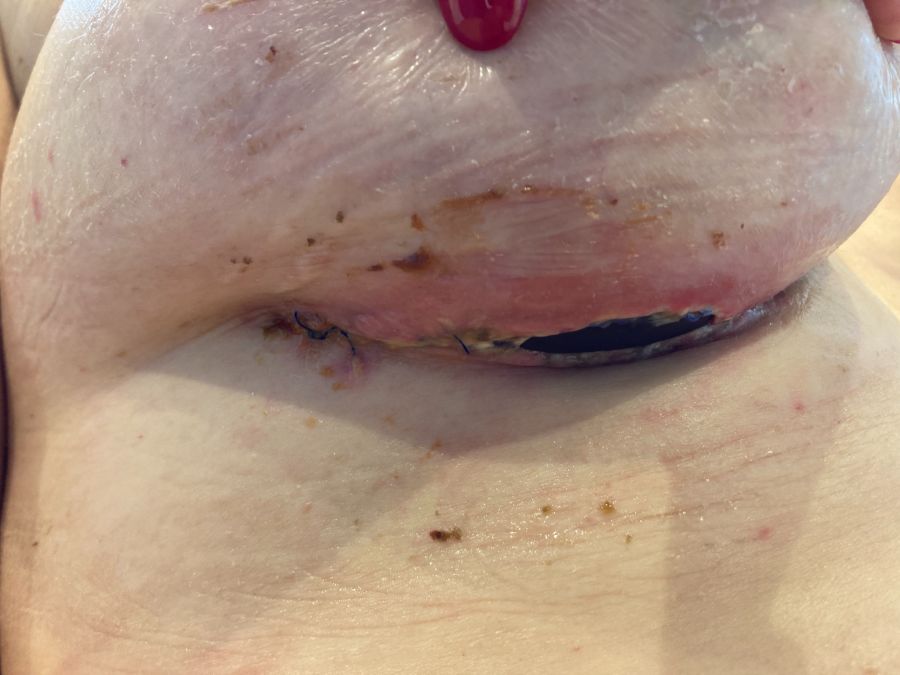 Wenige Wochen nach der Operation war die Wunde infiziert, das Implantat sichtbar. Nau.ch zeigt das Bild mit Einverständnis der Patientin.