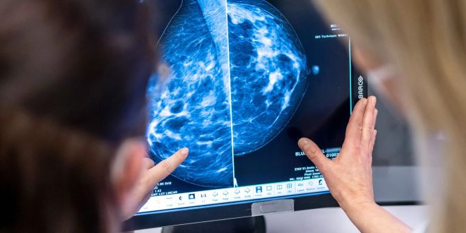 Bei Frauen ist Brustkrebs die verbreitetste Form von Krebs. Krebs