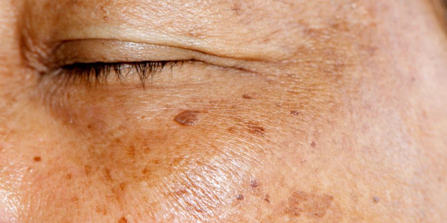 sonneneinstrahlung hyperpigmentation