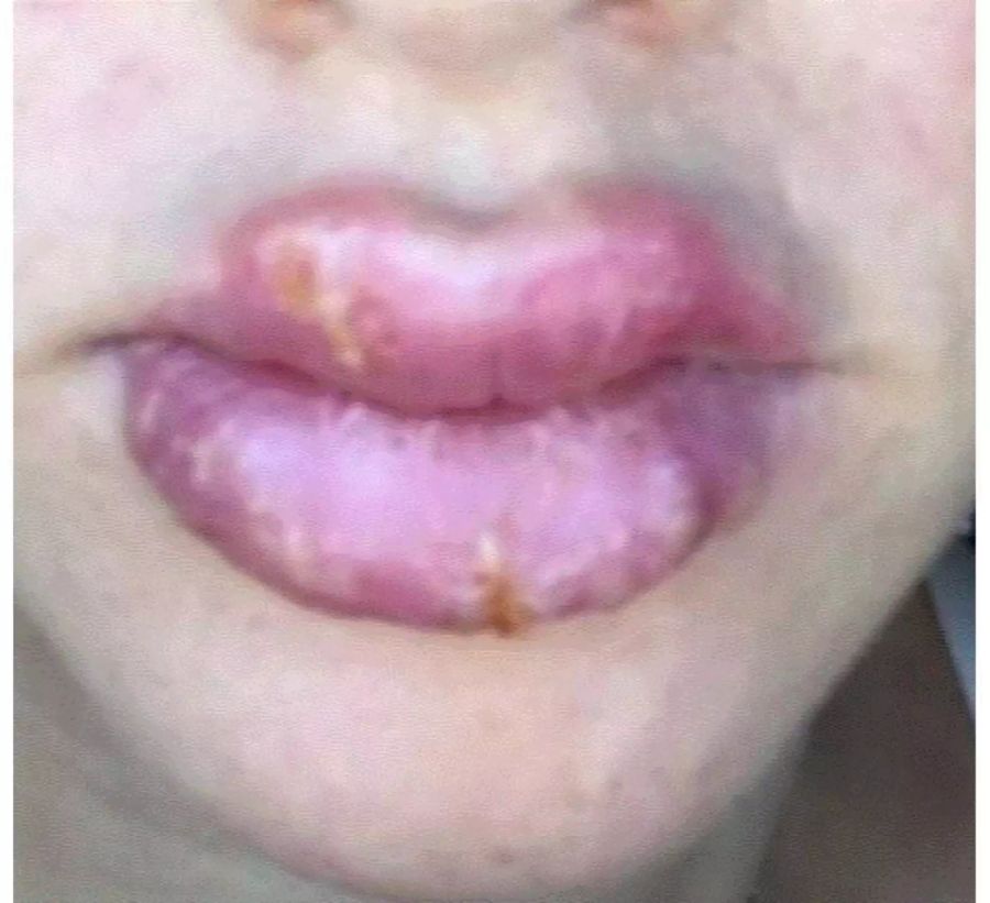 Die Lippen der 30-Jährigen platzten wüst auf.