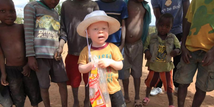 Die Körperteile von Albinos gelten in vielen Regionen Afrikas als magisch.