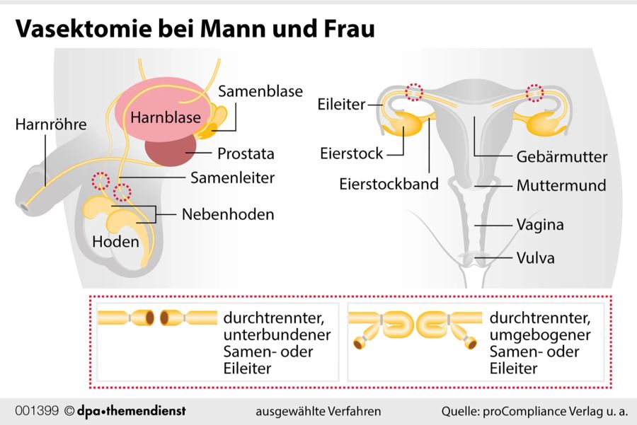 Grafik Hoden Eileiter Vasektomie Frau Mann