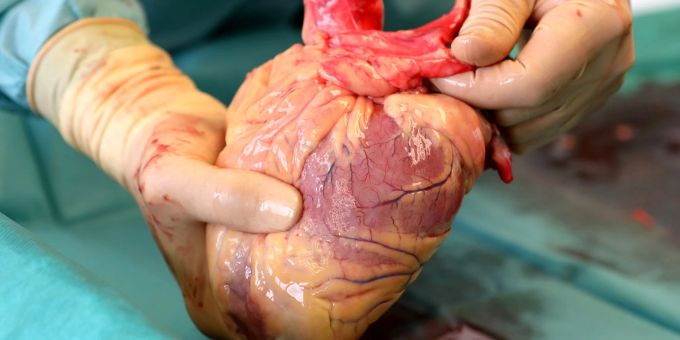 Ein Transplantationsmediziner hält das Herz eines Verstorbenen in den Händen, das kurz zuvor entnommen wurde. Ein Transplantationsmediziner hält das Herz eines Verstorbenen in den Händen, das kurz zuvor entnommen wurde.