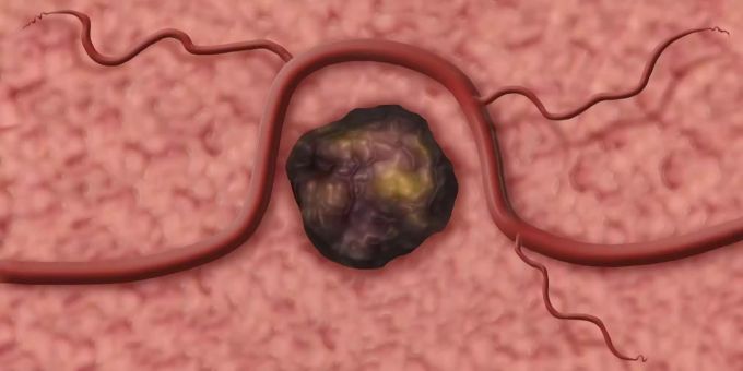 Der intakte Tumor in der Prostata. Der intakte Tumor in der Prostata.