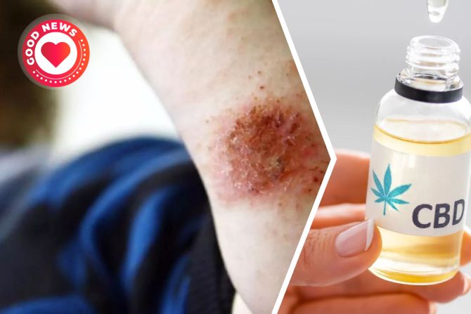 Neurodermitis CBD