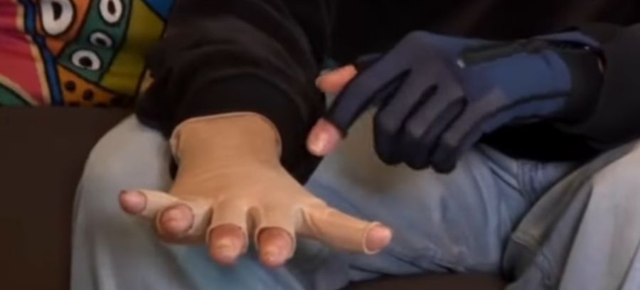 Auch könne sie den Daumen nicht mehr öffnen, sagt Palmieri.