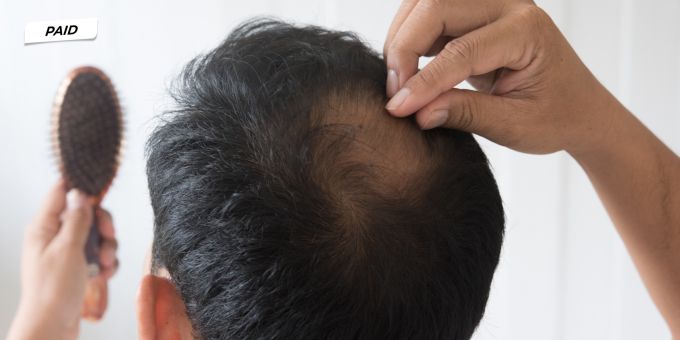 Männergesundheit - Haarausfall stoppen: Schweizer Lösung wirkt