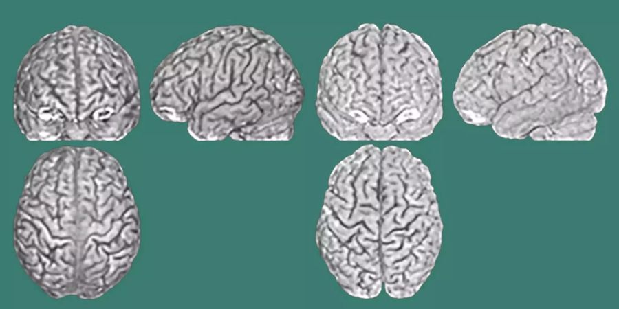 Je drei Hirnscans von zwei Zwillingen: Sogar bei eineiigen Zwillingen, welche die dieselbe DNA teilen, verlaufen die Furchen und Wülste des Gehirns einzigartig.