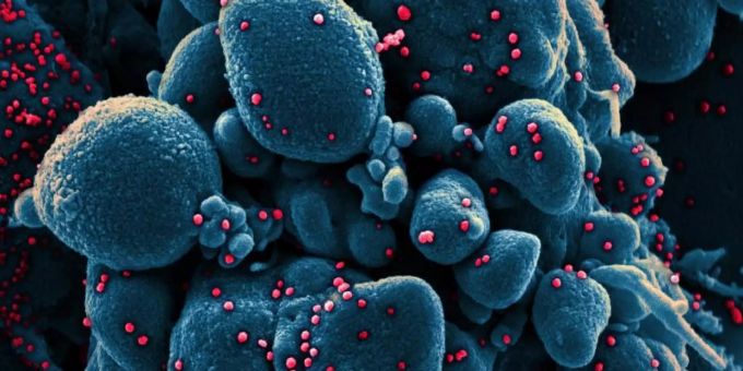 Eine mit SARS-CoV-2 infizierte Zelle. Möglicherweise gab es in Frankreich schon im Dezember einen Coronavirus-Fall. Foto: Niaid/Europa Press/dpa Eine mit SARS-CoV-2 infizierte Zelle. Möglicherweise gab es in Frankreich schon im Dezember einen Coronavirus-Fall. Foto: Niaid/Europa Press/dpa