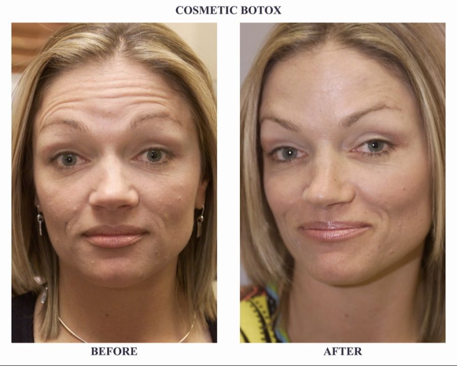 Botox