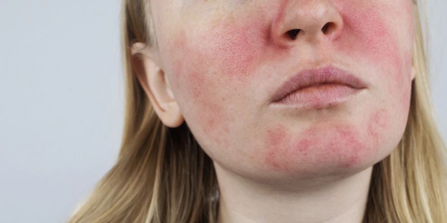 Rosacea, Rötungen im Gesicht