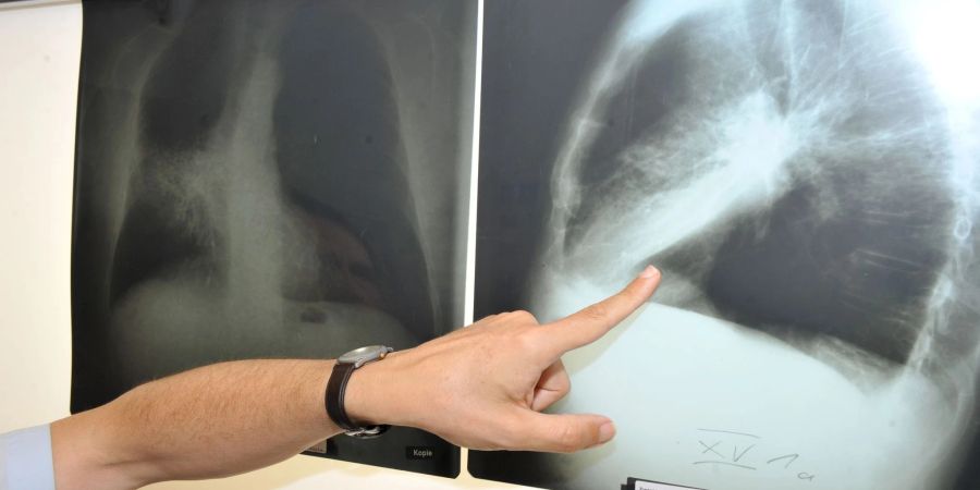 Das Risiko, in Deutschland an Krebs zu sterben, sinkt laut Forschern. Sorge bereitet den Medizinern allerdings die steigende Zahl an Lungenkrebs-Todesfällen bei Frauen.