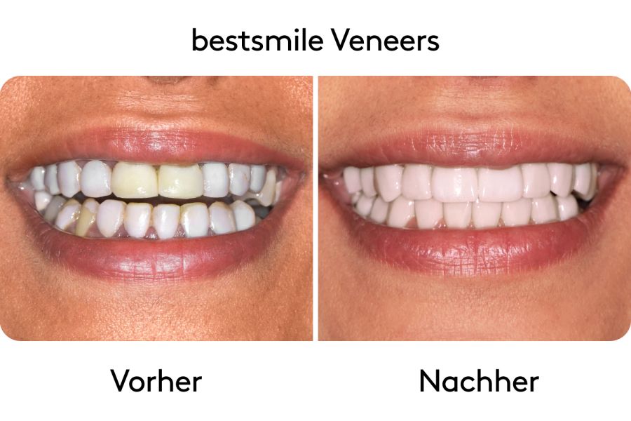 Bevor bestsmile deine finalen Veneers anbringt, siehst du mit dem Provisorium bereits im Vorfeld dein neues Lächeln. Es werden so lange Änderungen vorgenommen, bis dir das Endergebnis gefällt.