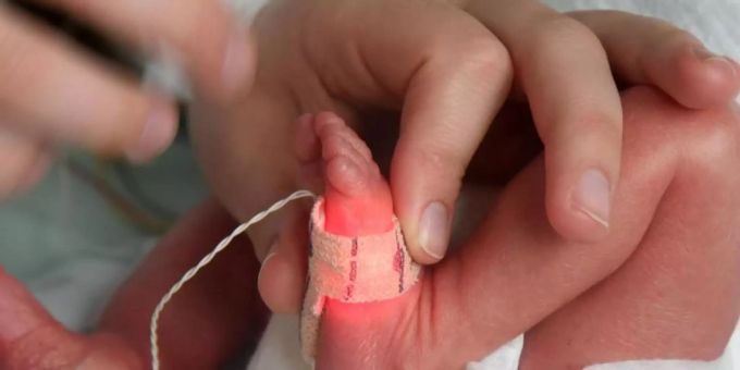 Bei extrem unreif geborenen Kindern bestehen grosse Risiken. Sie haben häufig Probleme mit Lunge, Hirn, Darm und Augen, die bis zum Erblinden führen können. Foto: Waltraud Grubitzsch/zb/dpa Bei extrem unreif geborenen Kindern bestehen grosse Risiken. Sie haben häufig Probleme mit Lunge, Hirn, Darm und Augen, die bis zum Erblinden führen können. Foto: Waltraud Grubitzsch/zb/dpa