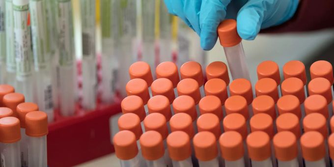 Proben für Corona-Tests werden für die weitere Untersuchung vorbereitet. Infektionen Abwasser Monitoring