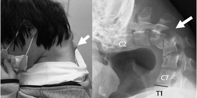 Ein junge Japaner entwickelte das Dropped-Head-Syndrom und konnte den Kopf nicht mehr heben. dropped head syndrom handy