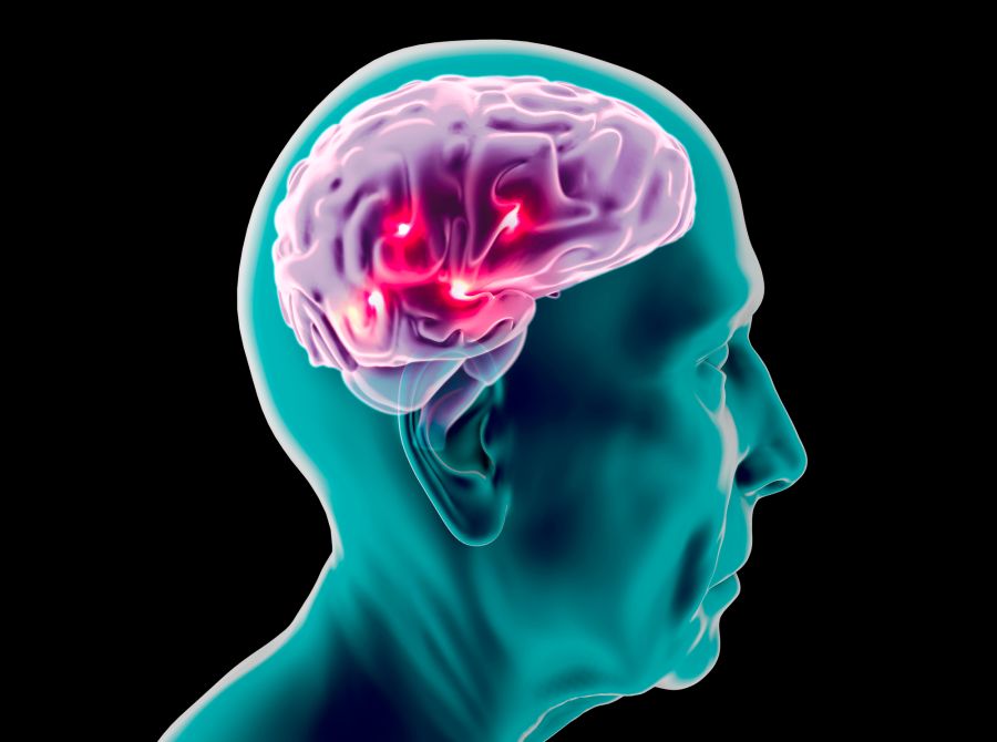 Bei Alzheimer-Patienten verklumpt das Tau-Protein im Gehirn. (Symbolbild)