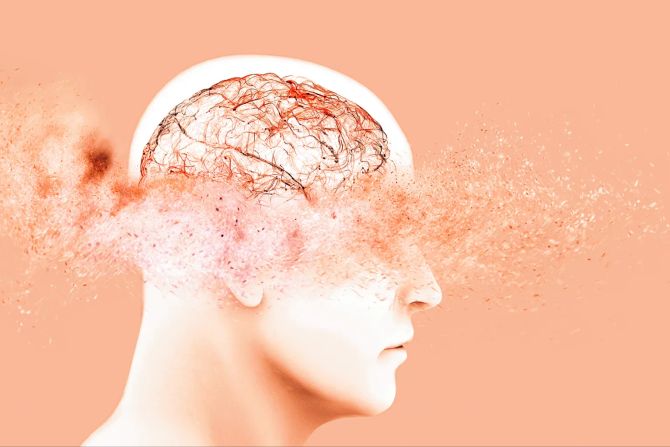 Jüngster Demenz-Patient Gehirn