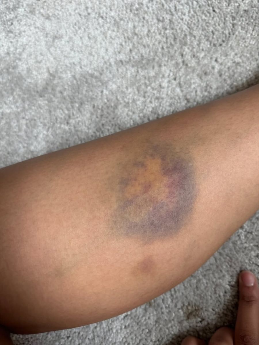 Jones erlitt offenbar mehrfach Schürfwunden und Blutergüsse.