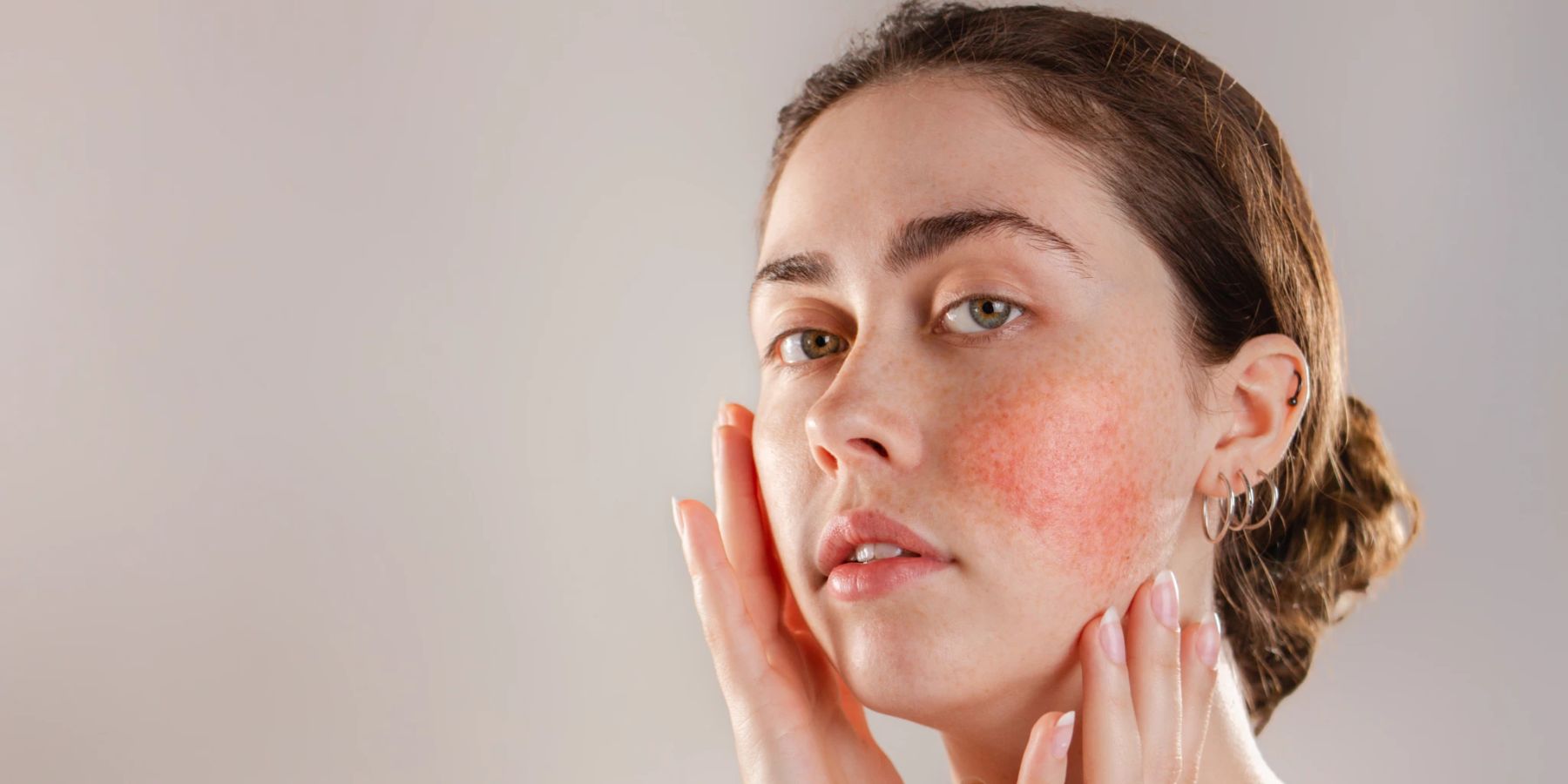 Rotes Gesicht Nach Cortisonspritze Wie Lange health.nau.ch