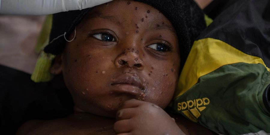 Neue Tests sollen die Ausbreitung von Mpox eindämmen helfen. (Archivbild)