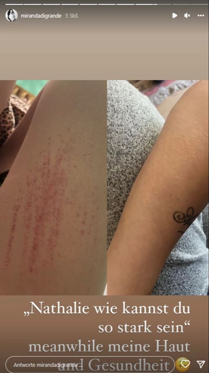 «GNTM»-Star Nathalie Volk zeigt ihren fiesen Hautausschlag. Nathalie Volk