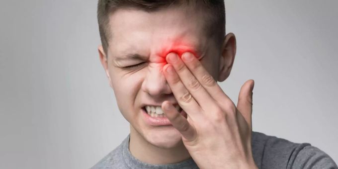 Bindehautentzündung der Augen. Mann mit Entzündung im Auge