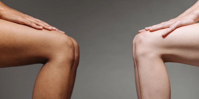Arthrose kann in den Kniegelenken auftreten. Knie