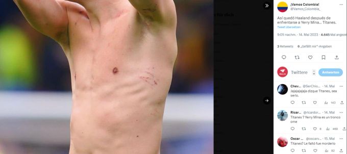 Erling Haaland mit Kratz-Spuren nach der Partie gegen Everton. erling haaland