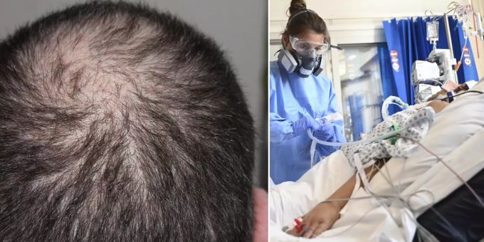 Briten schlagen Alarm - Führt Corona-Erkrankung zu Haarausfall?
