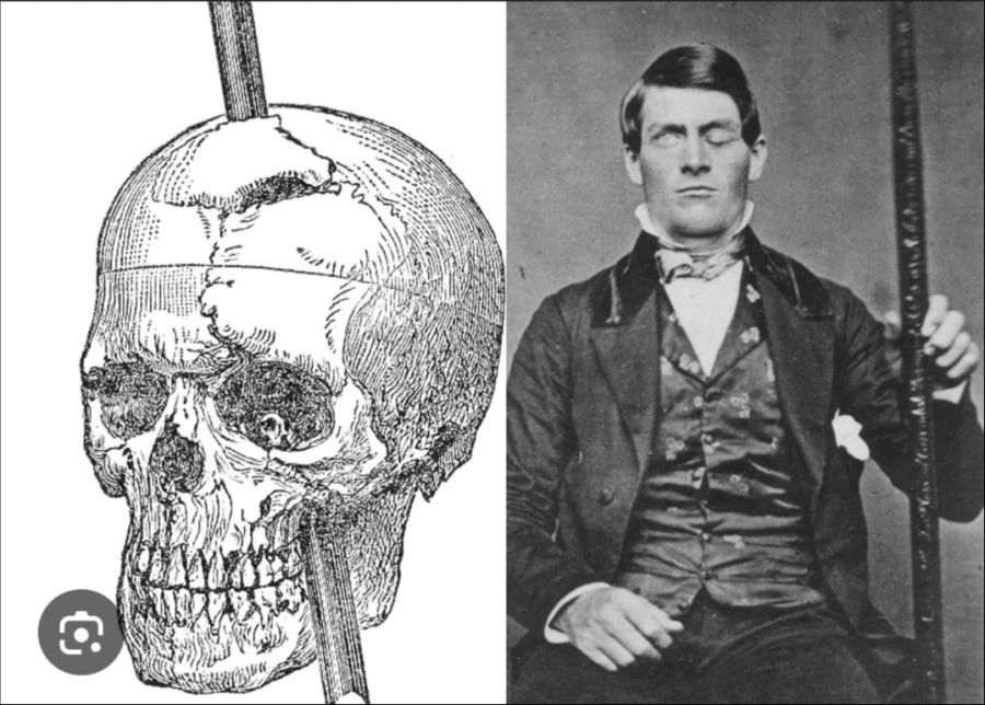 Bahnarbeiter Phineas Gage.