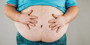 Bauch einer Person mit Adipositas