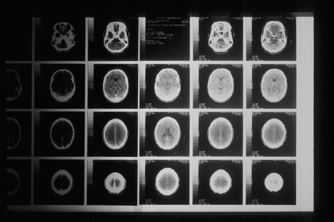 Sogenannte Plaques kann sich im Gehirn absetzen und führt dazu, dass Nervenzellen beschädigt werden - dadurch kommt es wahrscheinlich zu Alzheimer und anderen Demenzerkrankungen. (Symbolbild) alzheimer plaque