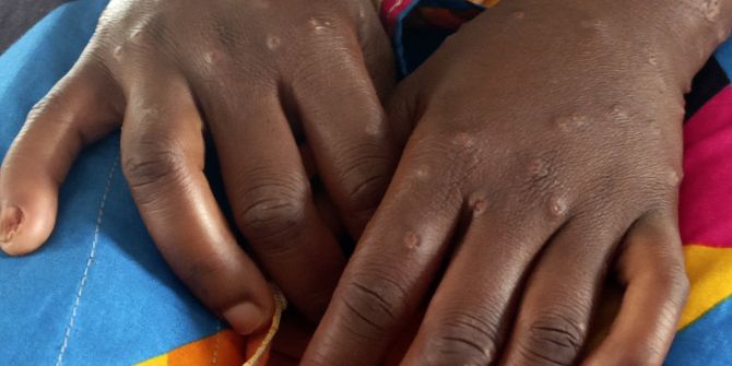 Westafrika Mpox