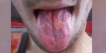 Zerfressene Zunge