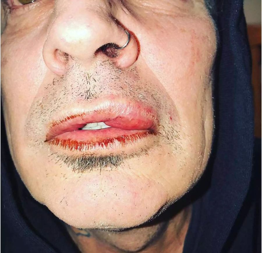 Der Drummer postete dieses Bild seiner blutigen Lippe. Mittlerweile hat er das Bild wieder gelöscht.