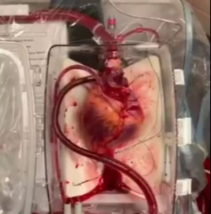 Das «tote» Herz, das transplantiert wurde. Herz