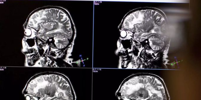 Braucht es neue Menschenrechte? Neurotechnologie