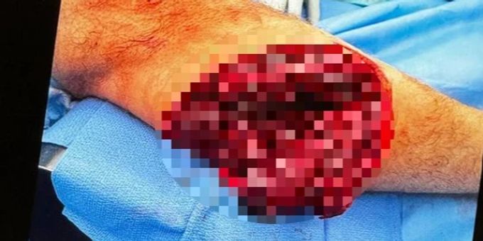 Fleischwunde an Wade - Kilde teilt Horror-Bilder von Lauberhorn-Sturz