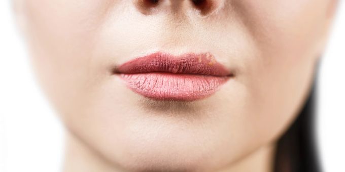 Herpes-Bläschen können nicht nur um die Lippen entstehen. frauenmund mit herpes