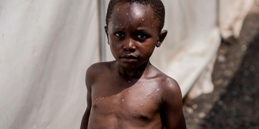 Für Kinder kann Mpox besonders gefährlich sein (Archivbild)