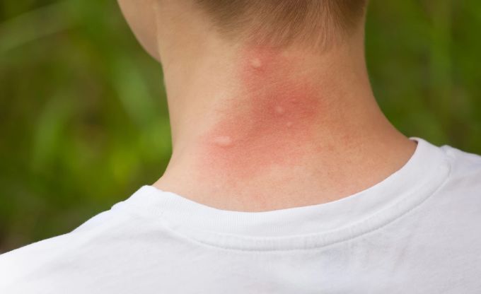 Schwellungen, Juckreiz – das sind gängige Symptome nach einem Mückenstich. Geschwollene Mückenstiche am Hals