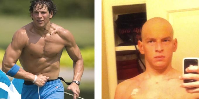 David Fajgenbaum vor und nach dem ersten Ausbruch. David Fajgenbaum medizin