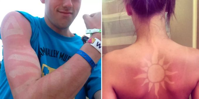 Sonnenbrand-Tattoo - Gefährlicher Trend sorgt für Kopfschütteln