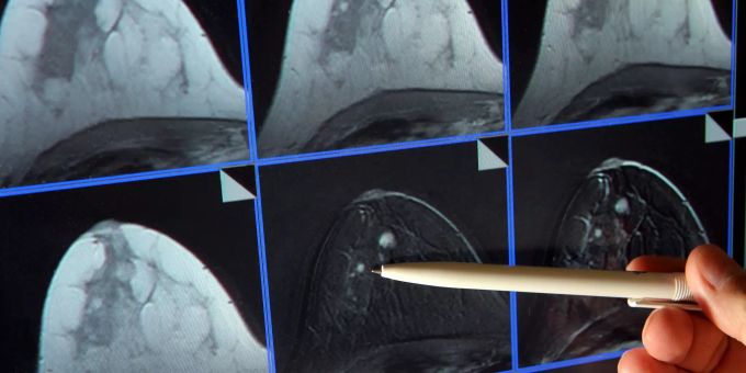 Auf der Bildschirmdarstellung einer Magnetresonanz-(MR)-Mammographie ist ein winziger Tumor in der Brust einer Patientin zu sehen. (Symbolbild) Künstliche Intelligenz
