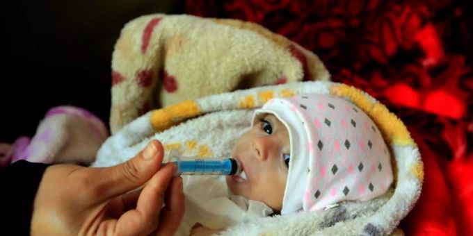 Ein unterernährtes Baby. hungersnot