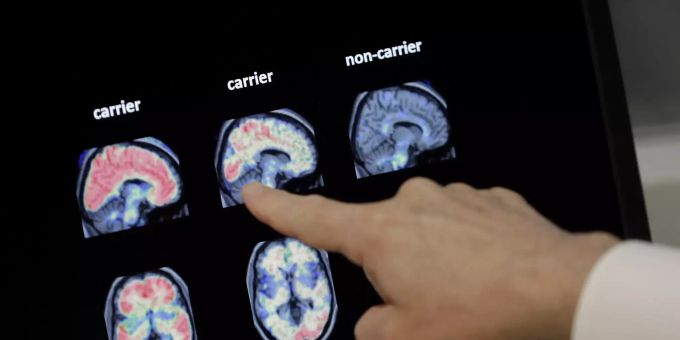 Für ihre Untersuchung nutzten Forscher unter anderem rund 400 postmortale Gehirnproben von Alzheimer-Patienten (Symbolbild). bluttest